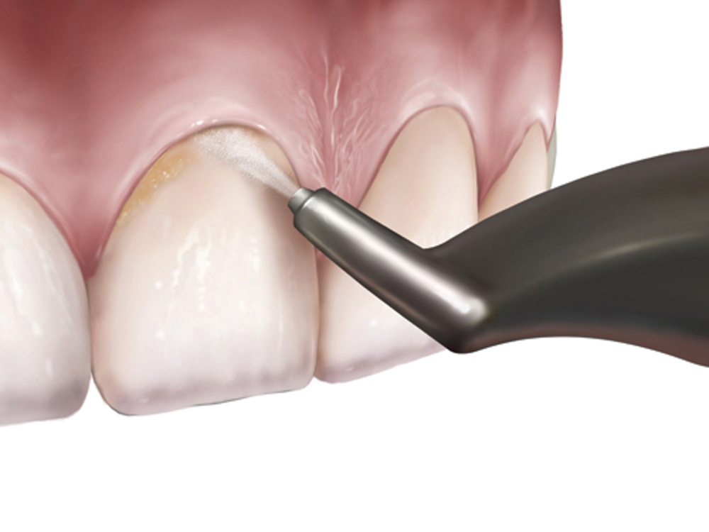 Sistema De Blanqueamiento Dental Airprophy Bicarbonato a presion agua & aire - Imagen 8