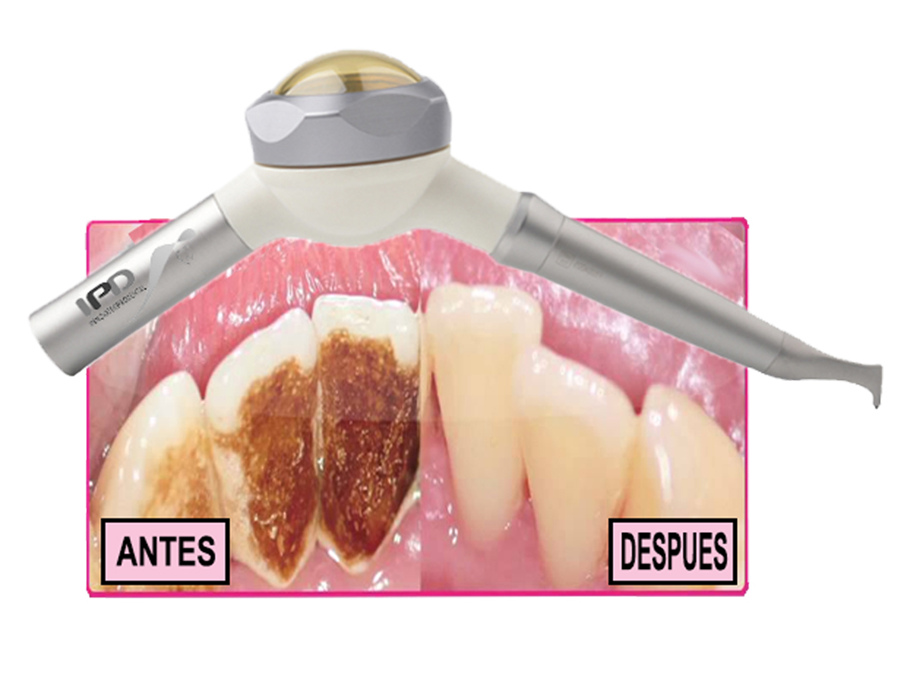 Sistema De Blanqueamiento Dental Airprophy Bicarbonato a presion agua & aire