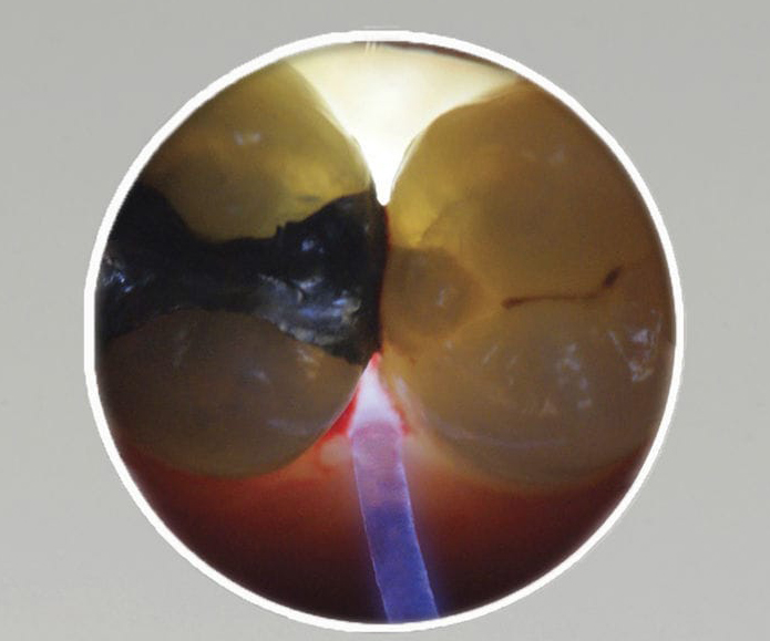 LAMPARA DE EXAMEN PARA DETECTAR FISURAS LUMINDEX 3 - Imagen 4